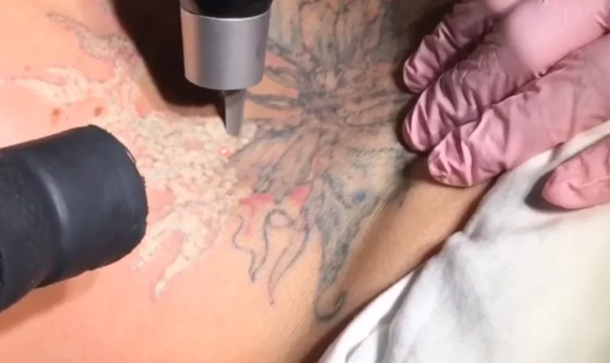 Melbourne tattoo removal