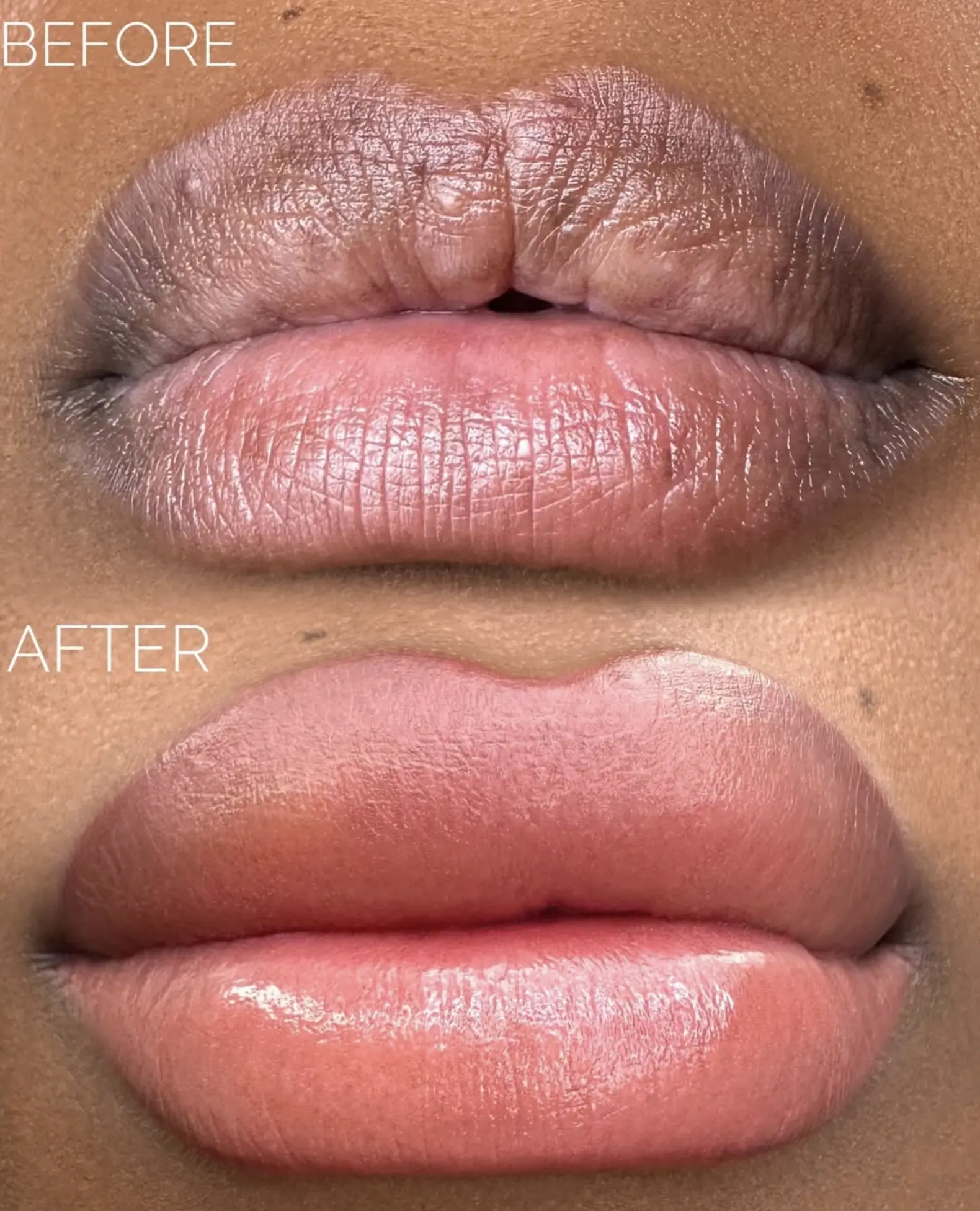 lip neutralization